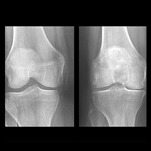 Knee x-rays.